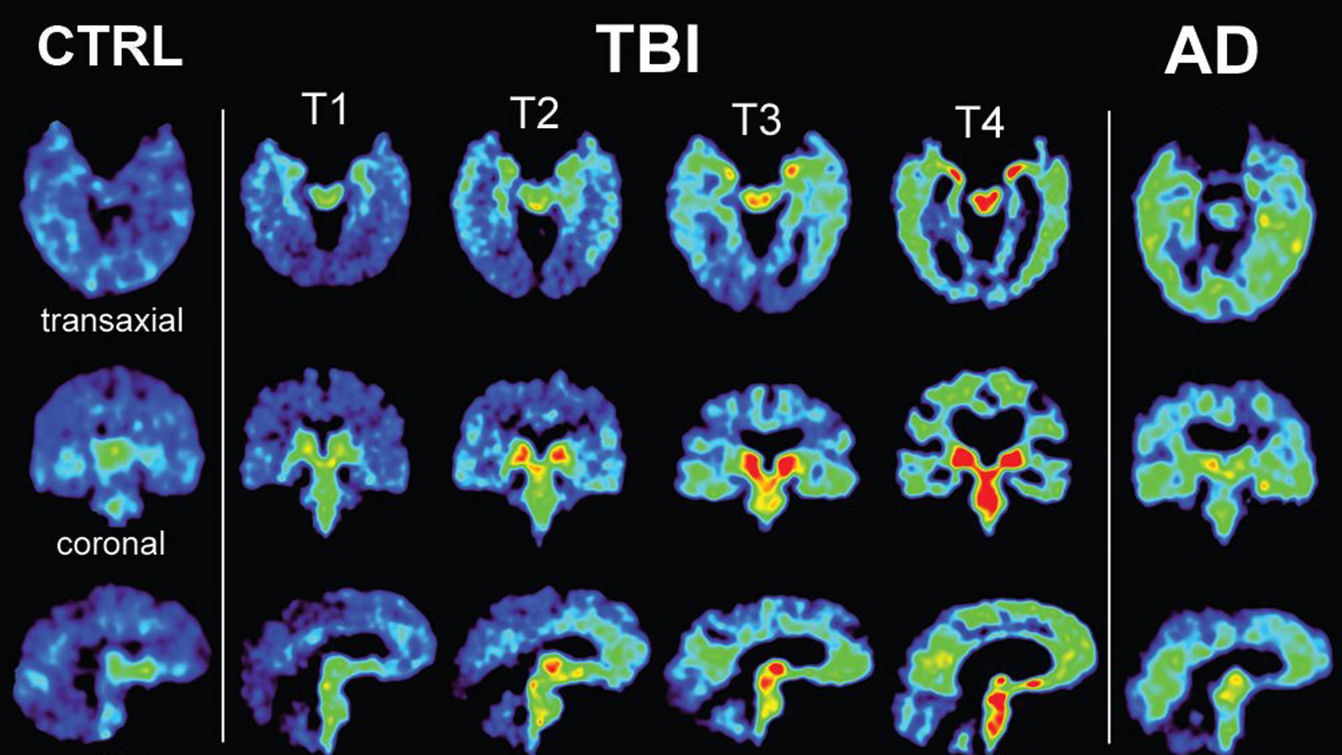 The list of football players with a brain disease called chronic traumatic encephalopathy, or CTE, continues to grow. The neurodegenerative brain disease can be found in individuals who have been exposed to repeated head trauma.