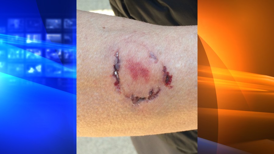 A woman was bitten by another woman after she sprayed the suspect's dog with pepper spray to fend of an attack at Anthony Chabot Regional Park in Castro Valley on Jan. 3, 2019. (Credit: East Bay Regional Park District Police Department)