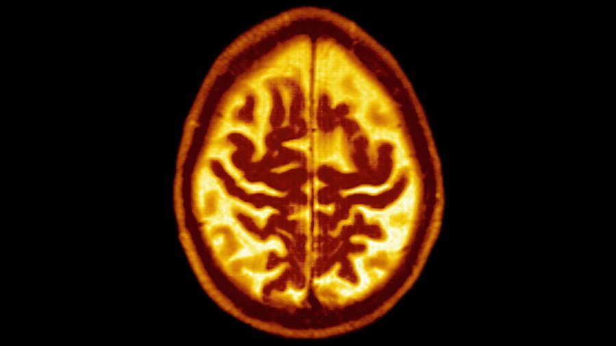 A simple blood test could predict if a patient will develop Alzheimer's disease up to 16 years before symptoms begin, a new study finds. (Credit: Getty Images via CNN Wire)