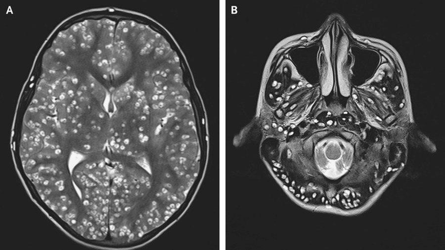 Damage-causing cysts were seen on MRI scans of the patient's cerebral cortex and brain stem. (Credit: Dr. Nishanth Dev/Dr. S. Zafar Abbas/ESIC Medical College & Hospital)