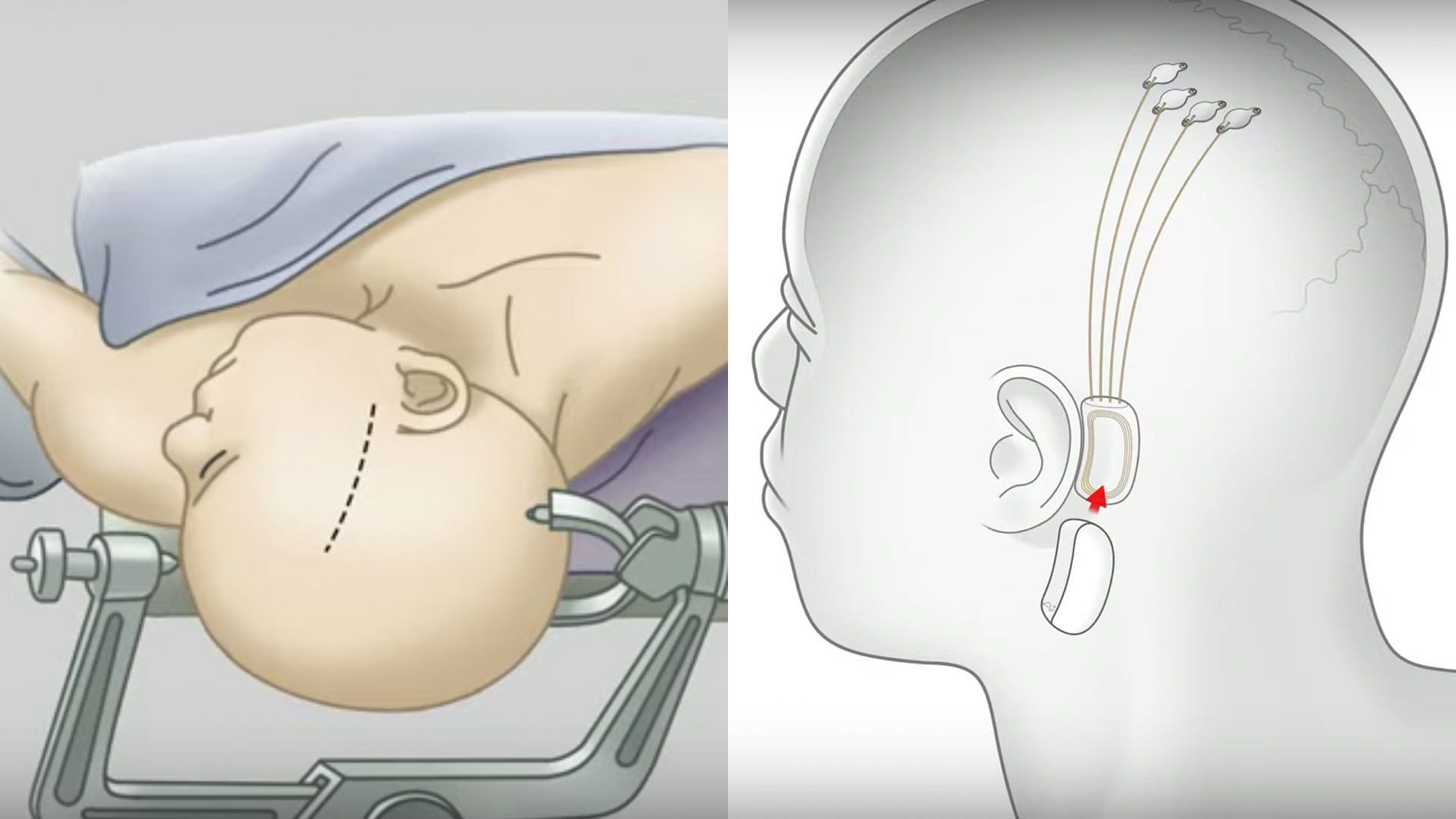 Neuralink devices, shown in renderings from a company presentation, will consist of a tiny chip connected to 1,000 wires measuring one-tenth the width of a human hair.