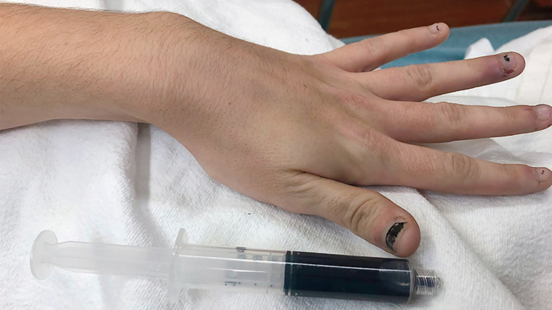 The woman's hand is seen next to a vial of blue blood. (Credit: New England Journal of Medicine)