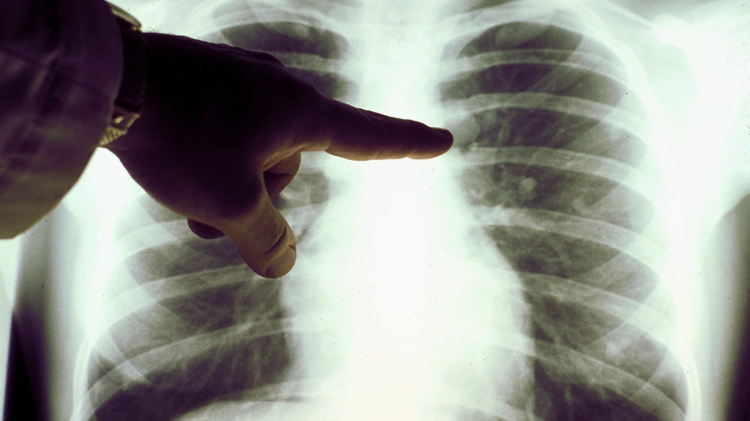 A view of a close up of a lung x-ray of a cigarette smoker in an undated photo. (Credit: American Cancer Society via Getty Images)