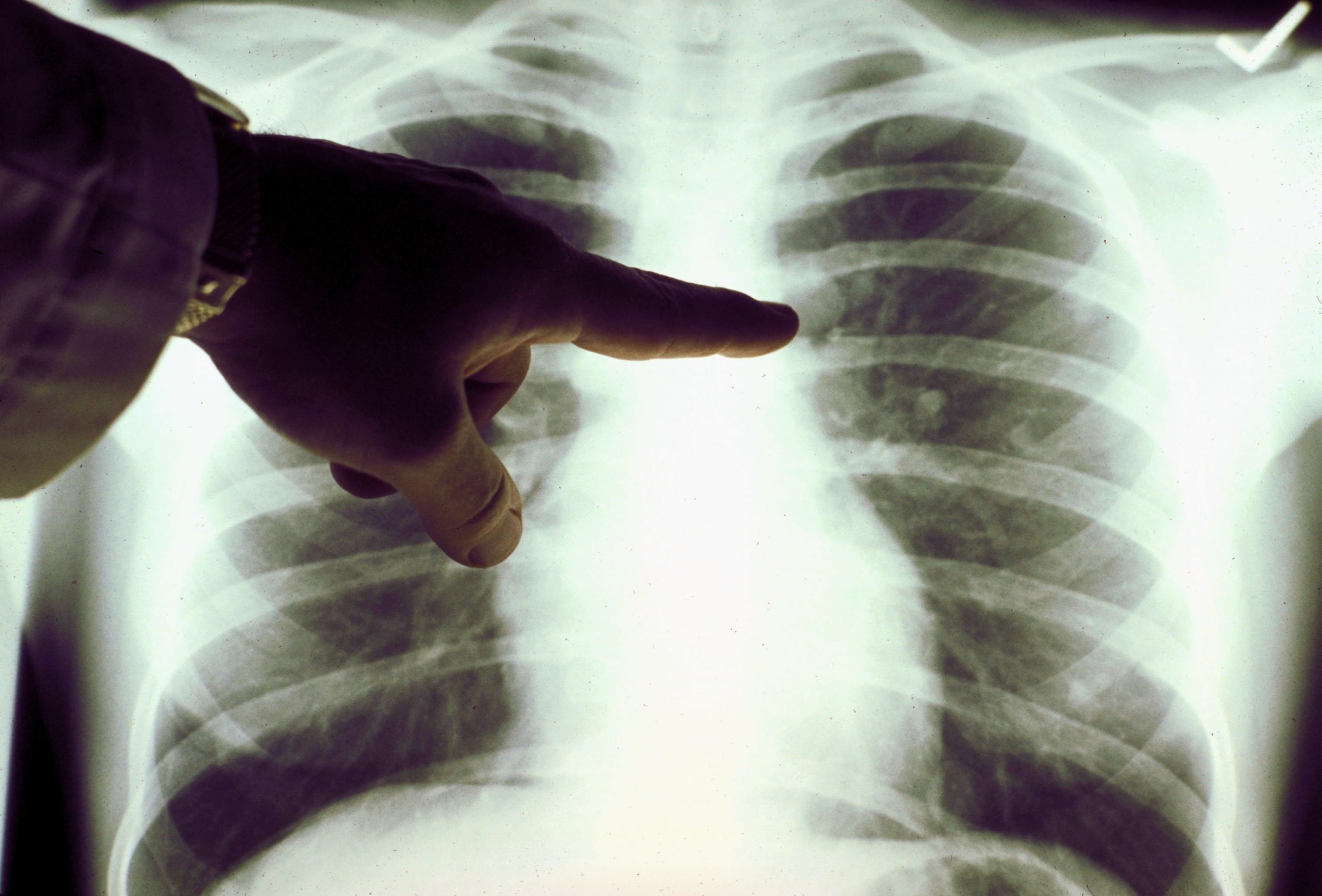 A view of a close up of a lung x-ray of a cigarette smoker in an undated photo. (Credit: American Cancer Society via Getty Images)