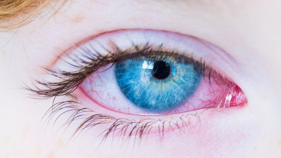 Symptoms include redness in both eyes. (Shutterstock)