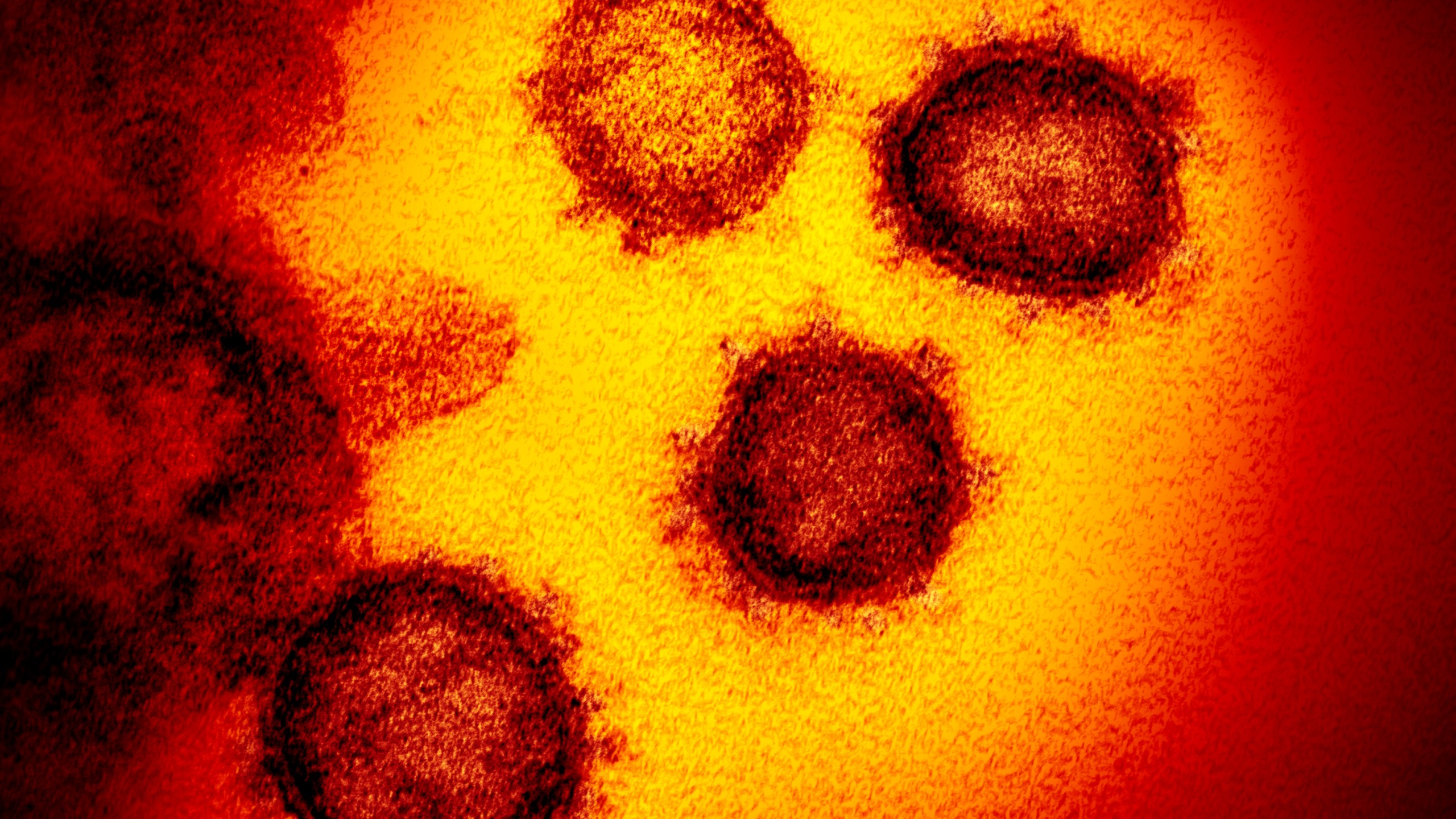 This undated electron microscope image made available by the U.S. National Institutes of Health in February 2020 shows the Novel Coronavirus SARS-CoV-2. Also known as 2019-nCoV, the virus causes COVID-19. The sample was isolated from a patient in the U.S. On Tuesday, April 21, 2020, U.S. health regulators OK'd the first coronavirus test that allows people to collect their own sample at home, a new approach that could help expand testing options in most states. The sample will still have to be shipped for processing back to LabCorp, which operates diagnostic labs throughout the U.S. (NIAID-RML via AP)