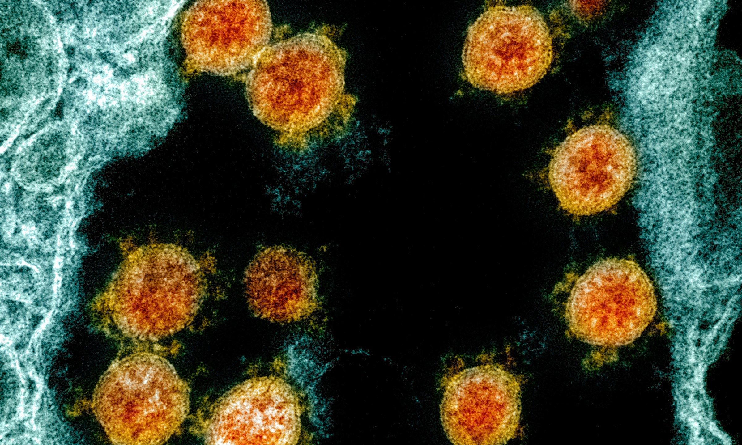 This electron microscope image made available and color-enhanced by the National Institute of Allergy and Infectious Diseases Integrated Research Facility in Fort Detrick, Md., shows Novel Coronavirus SARS-CoV-2 virus particles, orange, isolated from a patient. (NIAID/National Institutes of Health via AP)