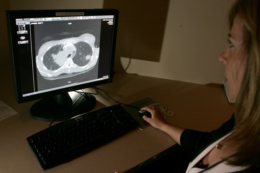 A file photo from Aug. 17, 2005 shows radiology technologist Mary McPolin looking at a CT scan of a lung with a tumor at the UCSF Comprehensive Cancer Center in San Francisco. (Justin Sullivan/Getty Images)