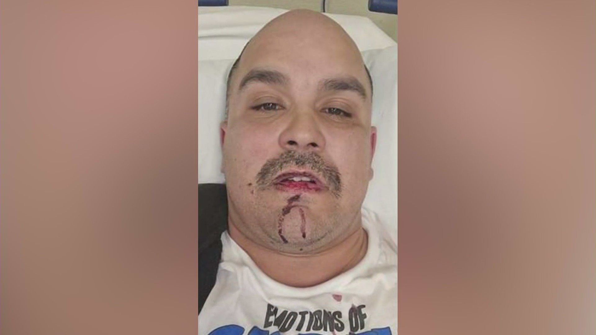 David Velasquez was hospitalized after being brutally beaten by a man who reportedly yelled homophobic slurs at him in West Hollywood on March 17, 2024. (David Velasquez)