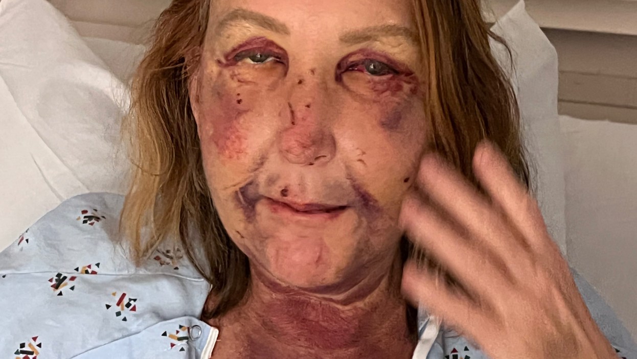 Venice Canal Attack Victim