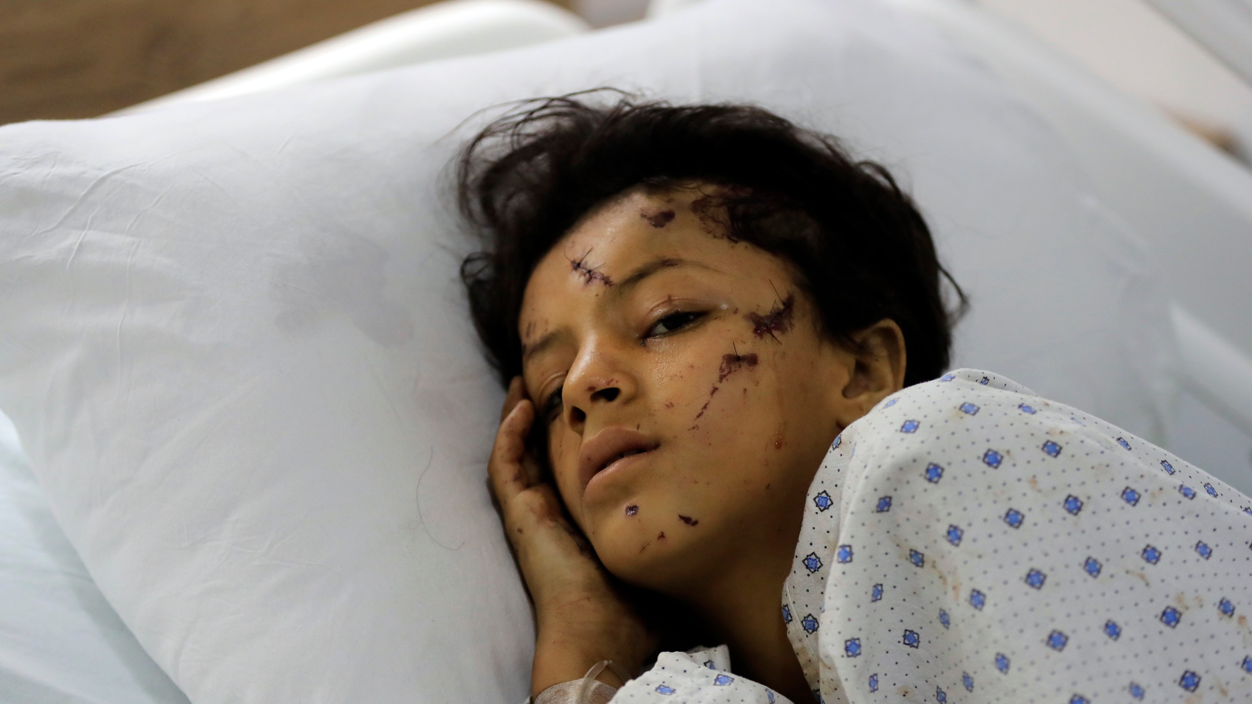 A wounded girl lies in a hospital bed in the southern village of Saksakieh, Lebanon, Tuesday, Sept. 24, 2024. (AP Photo/Mohammed Zaatari)