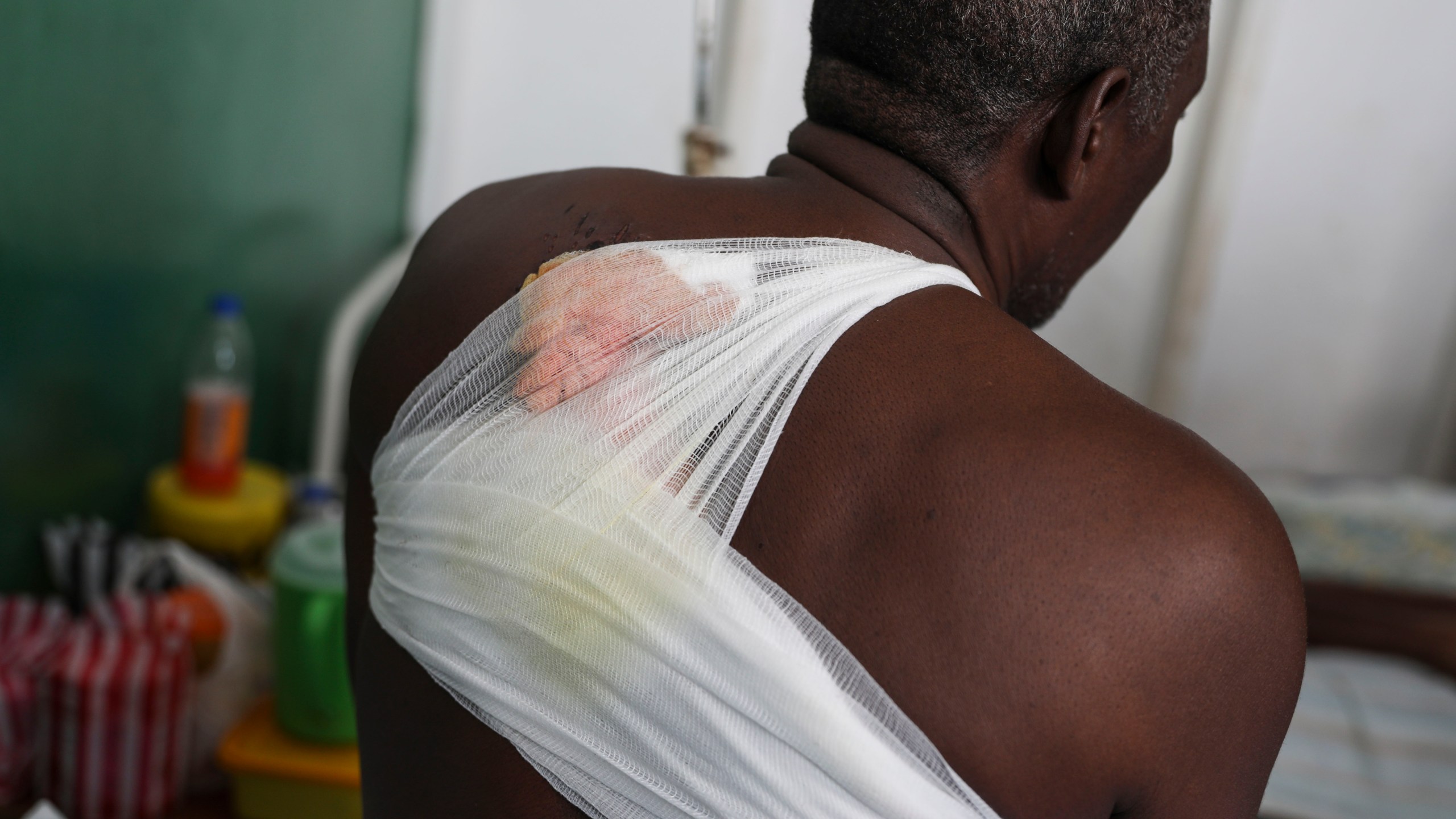 Tcharlit Charles, wounded by a bullet during armed gang attacks, sits on a bed at Saint Nicolas hospital in Saint-Marc, Haiti, Sunday, Oct. 6, 2024. (AP Photo/Odelyn Joseph)