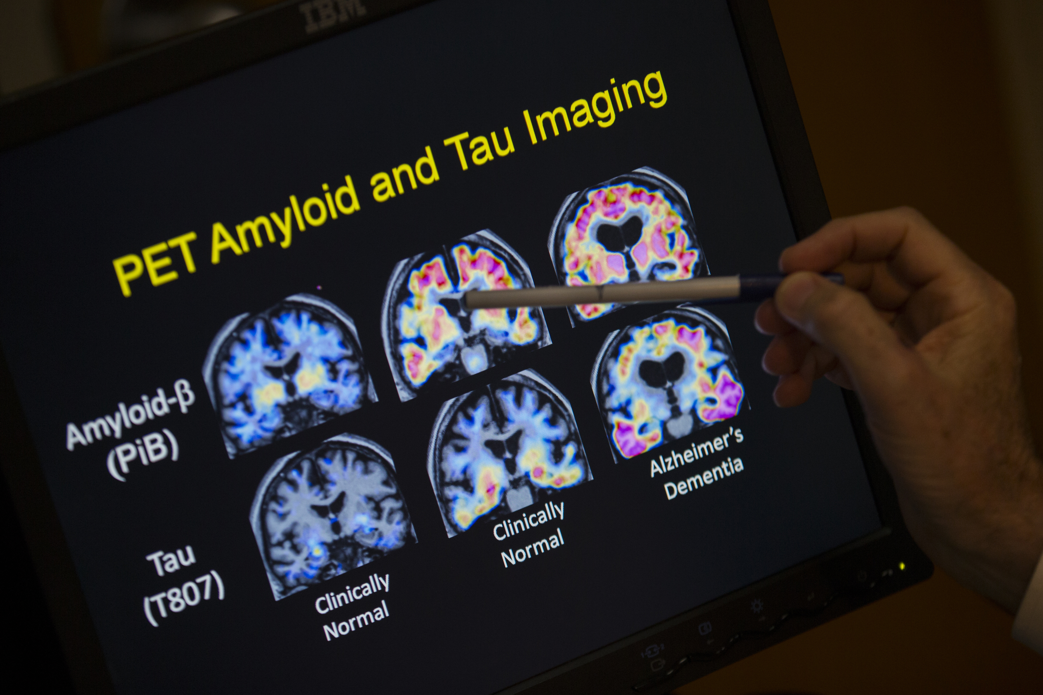 FILE - R. Scott Turner, Professor of Neurology and Director of the Memory Disorder Center at Georgetown University Hospital, points to PET scan results that are part of a study on Alzheimer's disease at Georgetown University Hospital, in Washington, May 19, 2015. (AP Photo/Evan Vucci, File)