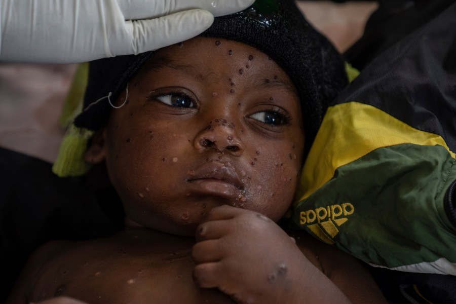 Emile Miango, de 2 años de edad y paciente con viruela símica, el 4 de septiembre de 2024, en un hospital en Kamituga, Congo. (AP Foto/Moses Sawasawa, Archivo)