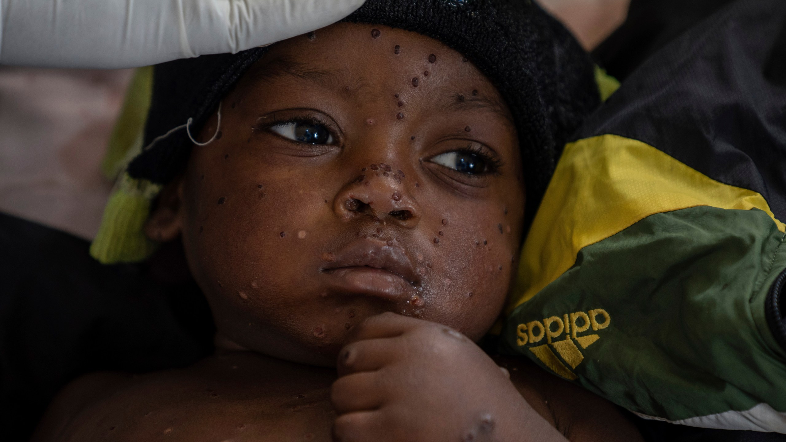 FILE - 2 year old Emile Miango, who has mpox, lies in a hospital, in Kamituga, South Kivu province, Sept. 4, 2024, which is the epicenter of the world's latest outbreak of the disease in eastern Congo. (AP Photo/Moses Sawasawa, file)