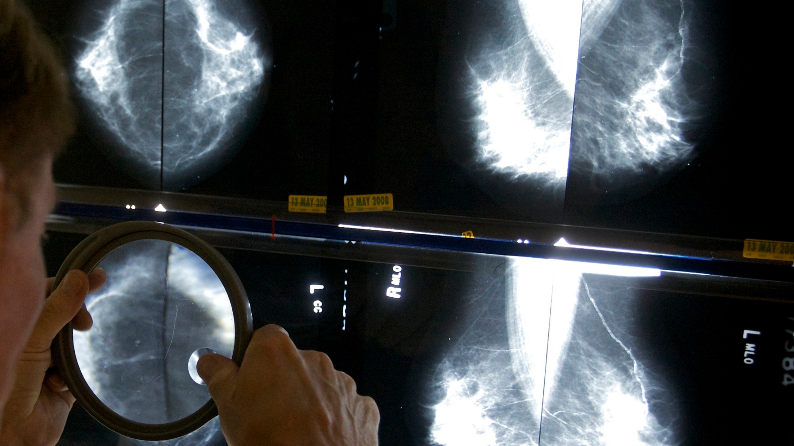 FILE - A radiologist uses a magnifying glass to check mammograms for breast cancer in Los Angeles, May 6, 2010. (AP Photo/Damian Dovarganes, File)