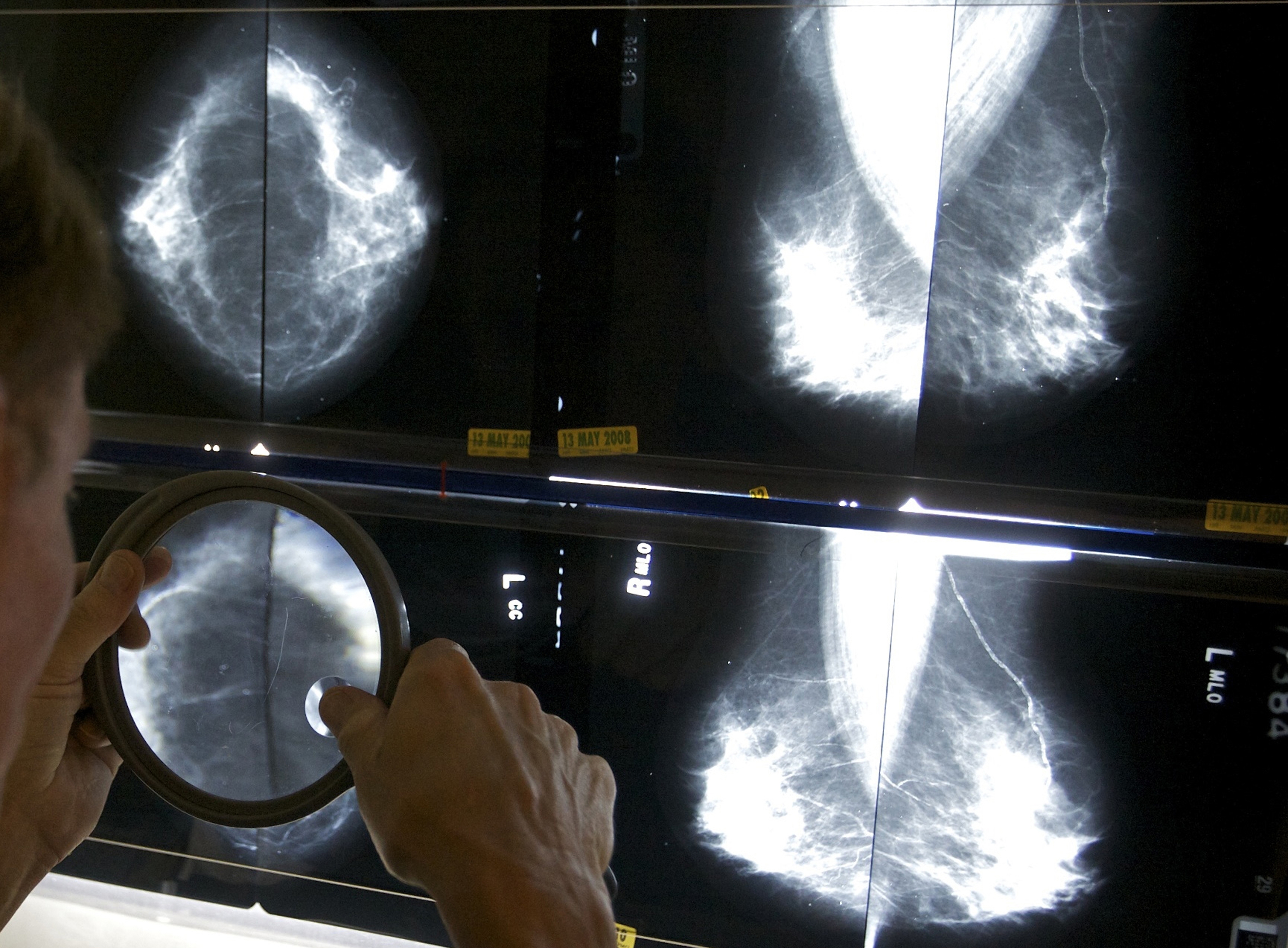 FILE - A radiologist uses a magnifying glass to check mammograms for breast cancer in Los Angeles, May 6, 2010. (AP Photo/Damian Dovarganes, File)