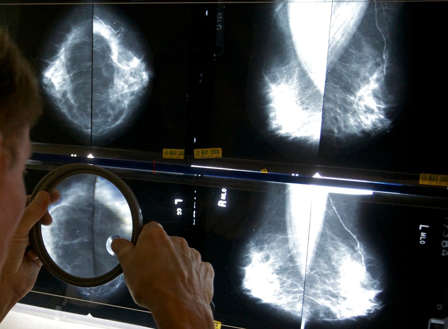 FILE - A radiologist uses a magnifying glass to check mammograms for breast cancer in Los Angeles, May 6, 2010. (AP Photo/Damian Dovarganes, File)